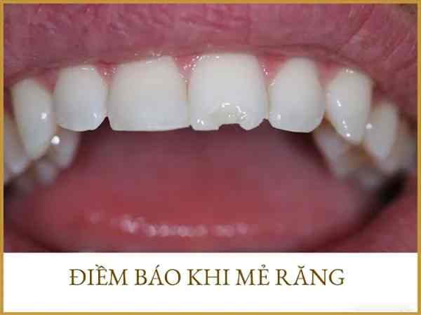 Bị mẻ răng theo vị trí răng có điềm gì?