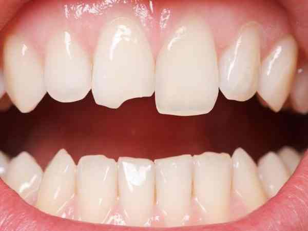 Bị mẻ răng có điềm gì, giải mã theo từng vị trí mẻ răng